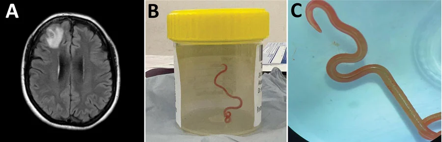Woman’s mystery illness turns out to be 3-inch snake parasite in her brain
